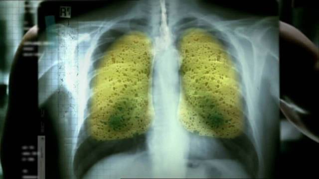 Καρκίνος του πνεύμονα: Πότε ο βήχας πρέπει να σας ανησυχήσει